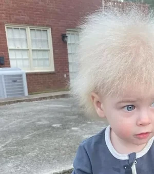 Criança faz sucesso nas redes por condição rara do cabelo