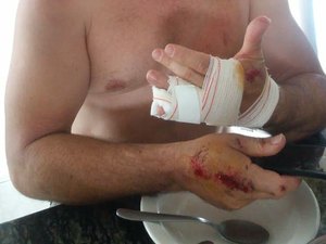 Fotógrafo é atacado por 5 cachorros quando transitava em motocicleta, em Arapiraca