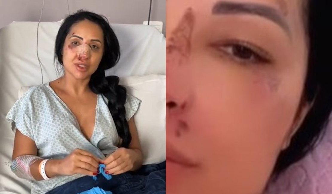 Irmã de Deolane retira curativo após estraçalhar nariz em briga e passar por cirurgia