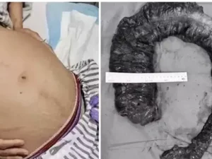 Médicos tiram cocô de 20 kg de intestino de mulher que ficou 10 dias sem evacuar