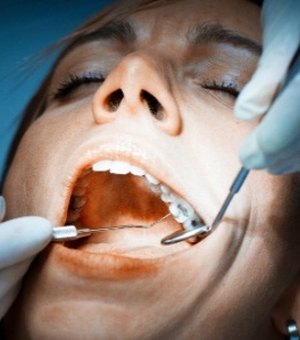 Obturações na boca podem aumentar níveis de mercúrio no sangue, diz estudo