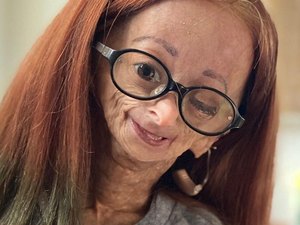 Morre Adalia Rose, youtuber de 15 anos que sofria da doença de “Benjamin Button”