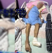 Enfermeira no DF amputa pé de idosa de 103 anos sem anestesia