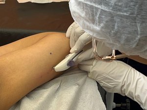 Secretaria da Primeira Infância promove capacitação para inserção do Implanon em Rio Largo