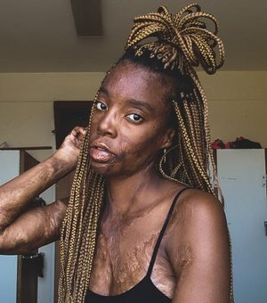 Sul-africana celebra suas cicatrizes e é elogiada na web