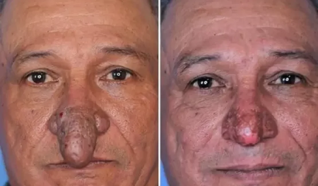 Após 6 anos procurando médicos, pintor com deformidade ganha novo nariz