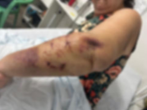 Turista atacada por três cães na orla de Paripueira perde movimentos dos dedos