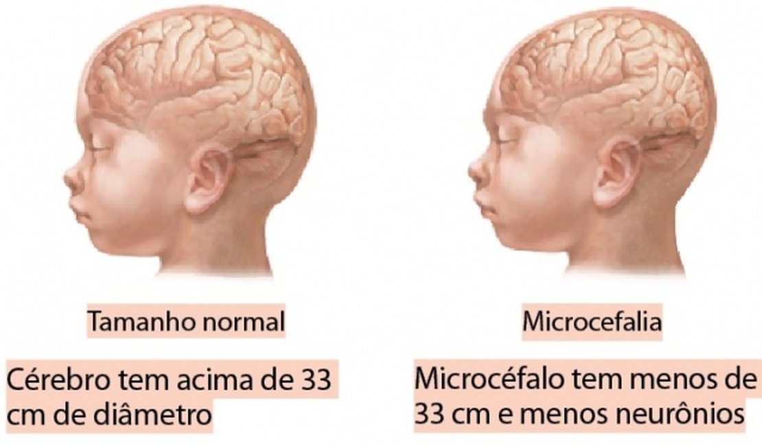 Casos de Microcefalia no Nordeste: Qual a causa para a manifestação da doença?