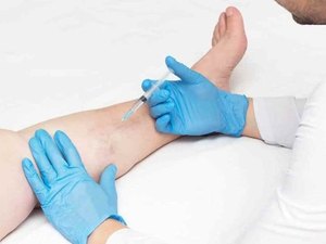 Saúde disponibiliza tratamento de microvasos e varizes no Pam Salgadinho
