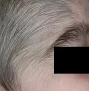 Minoxidil: produto anticalvície usado pelo pai fez crescer pelos em bebês