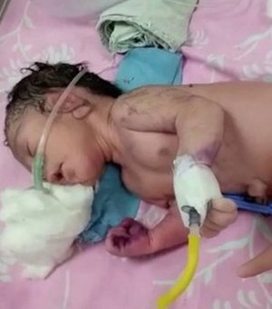 Índia registra nascimento de 'bebê-sereia', que atrai multidão a maternidade