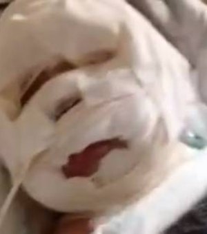 Bebê que teve rosto queimado em cirurgia passa por nova operação