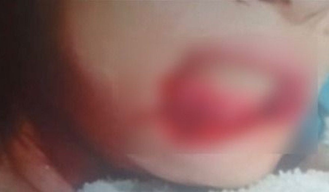 Polícia apura agressão brutal contra jovem que teve lábios arrancados pelo companheiro em Viçosa