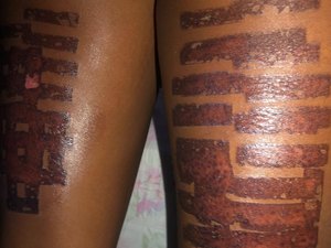 Modelo alagoana sofre queimaduras de segundo grau durante fotodepilação