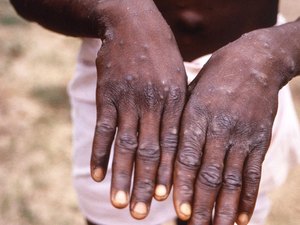 Varíola dos macacos: OMS anuncia resposta unificada contra doença