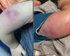 Bebê recebe alta após infecção grave pós-vacina em posto de saúde de Maceió