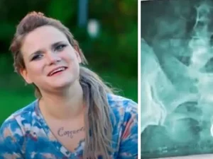 Americana é internada após vibrador ficar preso no reto: 'Entrei em pânico'