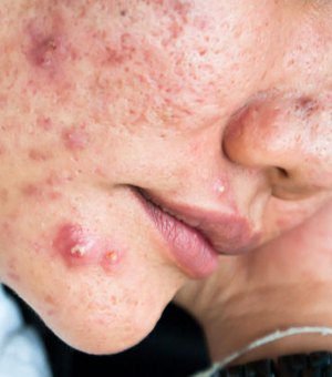 Adolescentes com crises graves de acne aguardam há oito meses por medicamento