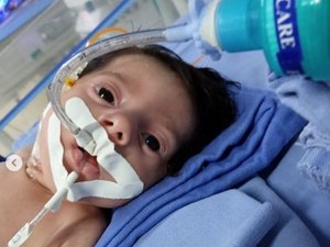 Bebê João Arthur pode ser diagnosticado com outra doença rara