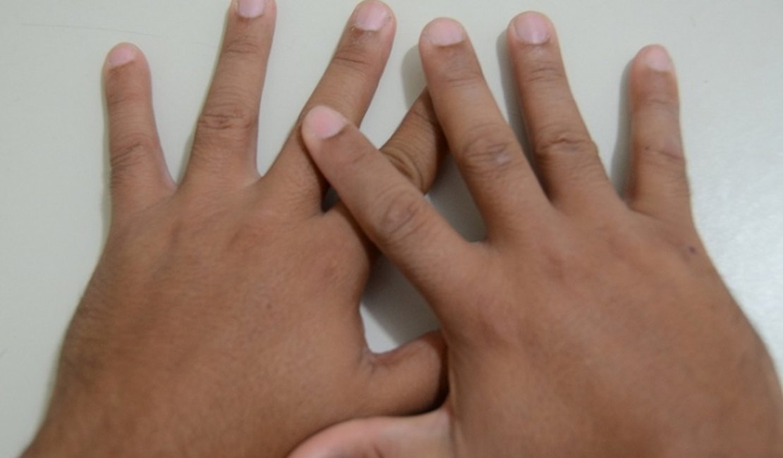 Sesau firma parceria para realizar Mutirões de Cirurgia da Mão