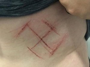 Suástica em corpo de jovem foi 'automutilação', diz polícia