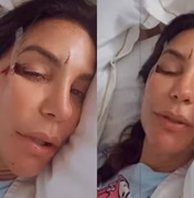 Ivete Sangalo surge em hospital com machucados no rosto e relata susto: 'Desmaiei'