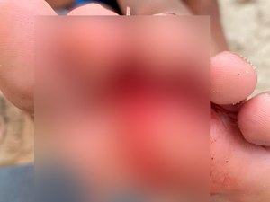 Criança tem pé perfurado por espinha de peixe em praia de Maceió