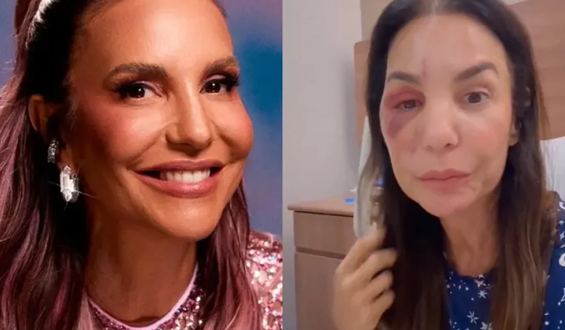 Ivete Sangalo mostra rosto com hematoma e esclarece estado de saúde
