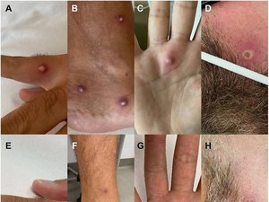 Homem é diagnosticado com HIV, covid e varíola do macaco