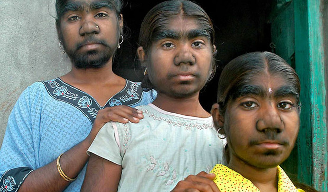 Mutação genética transforma três irmãs indianas em mulheres barbadas