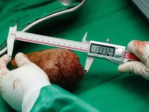Maior pedra nos rins do mundo é registrada no Guinness Book com 13,37 cm
