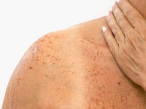 Câncer de pele: protetor solar não bloqueia totalmente raios UV