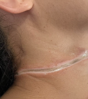 Garota fica com pescoço ferido após ser atingida por fio de internet que caiu de poste
