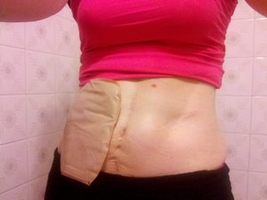 Defensoria busca o restabelecimento da distribuição de bolsas para ostomizados