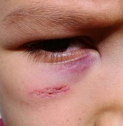 Criança quase tem olho perfurado após sofrer agressão em sala de aula