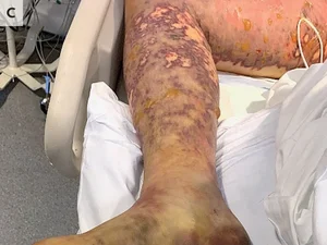 Jovem tem pernas amputadas após infecção por comida estragada