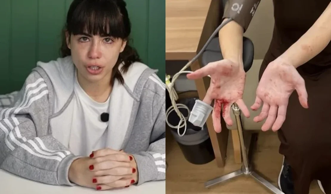 Atriz e influenciadora mostra ferimentos após reagir a assalto em SP