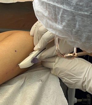 Secretaria da Primeira Infância promove capacitação para inserção do Implanon em Rio Largo