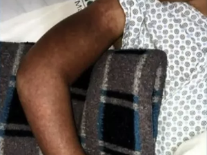 Criança de 10 anos tem braço sugado por ralo de piscina em Maceió