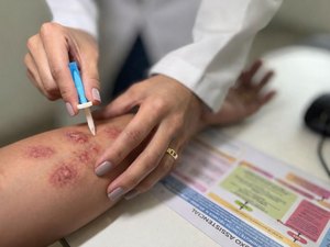 Hospital Ib Gatto Falcão contribui para a detecção precoce e orientação no enfrentamento à hanseníase