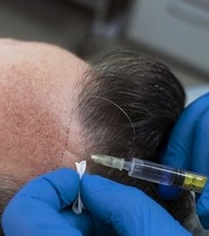 Gasto com transplante e implante de cabelo sobe 60% em um ano