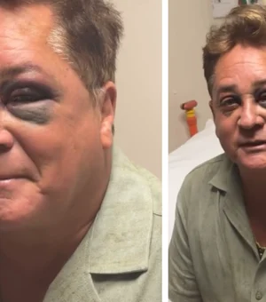 Leonardo aparece com olho roxo após sofrer acidente em pescaria; veja