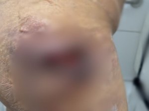 Advogada de vítima da dentista que aplicou silicone industrial fala sobre as medidas adotadas sobre o caso