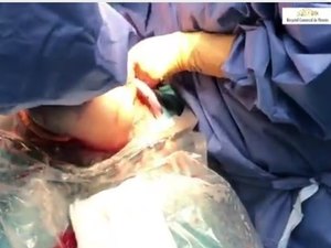 Vídeo mostra nascimento raro de bebê empelicado na Espanha