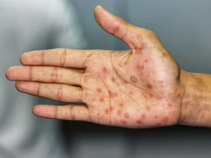 Casos de Sífilis avançam no Brasil, mas dados de 2026 apontam recuo em Alagoas