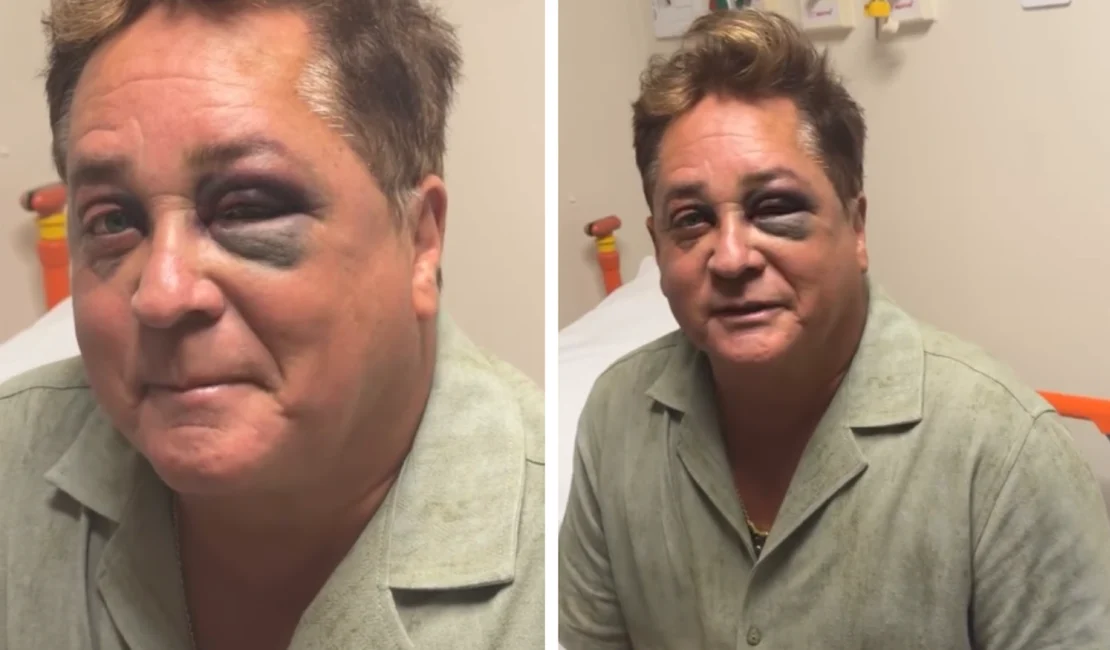 Leonardo aparece com olho roxo após sofrer acidente em pescaria; veja