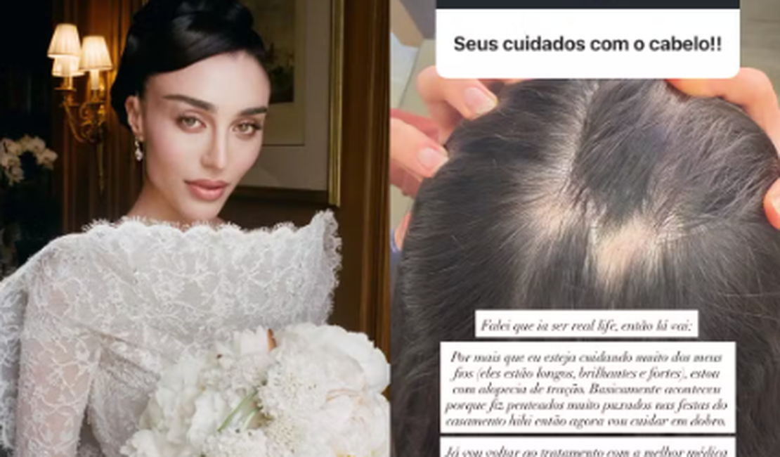 Elisa Zarzur revela alopecia após penteados do casamento: 'Vou cuidar em dobro'
