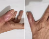 Mulher perde parte do dedo após fazer as unhas em salão e ter infecção