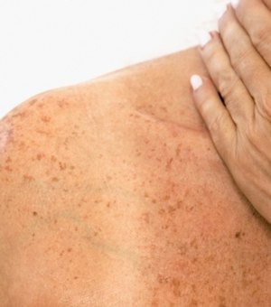 Pinta, mancha ou pequenos ferimentos na pele podem ser indicativos de câncer de pele