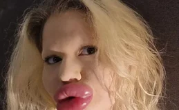Dentistas se recusam a atender “mulher com maiores lábios do mundo”